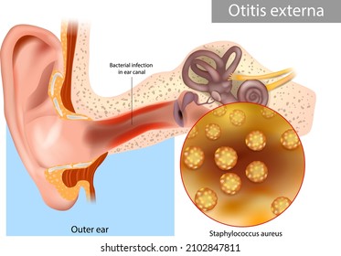 Otitis externa también llamó oreja del nadador. Inflamación del canal auditivo del Staphylococcus aureus. Anatomía de oído humano