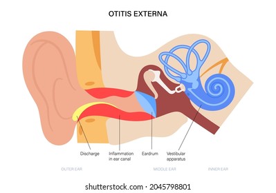 Otitis externa, swimmers ear disease. Pain and inflammation, earache in the human head. Medical checkup of hearing organs, neurology problems and treatment flat vector illustration. Poster for clinic