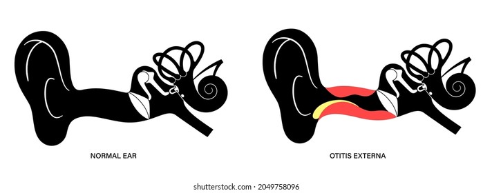 Otitis externa, swimmers ear disease. Pain and inflammation, earache in the human head. Medical checkup of hearing organs, neurology problems and treatment flat vector illustration. Poster for clinic