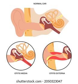 Otitis externa, swimmers ear disease. Pain and inflammation, earache in the human head. Medical checkup of hearing organs, neurology problems and treatment flat vector illustration. Poster for clinic