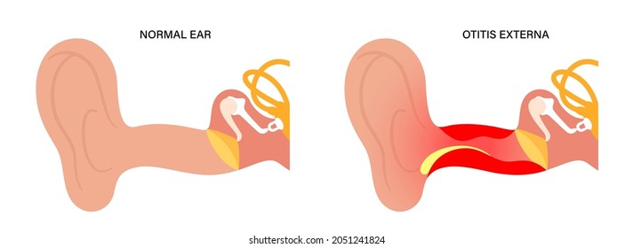 Otitis externa, swimmers ear disease. Pain and inflammation, earache in the human head. Medical checkup of hearing organs, neurology problems and treatment flat vector illustration. Poster for clinic