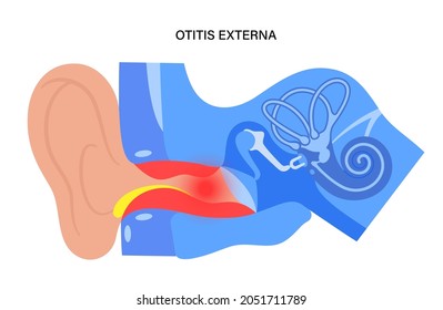 Otitis externa, swimmers ear disease. Pain and inflammation, earache in the human head. Medical checkup of hearing organs, neurology problems and treatment flat vector illustration. Poster for clinic