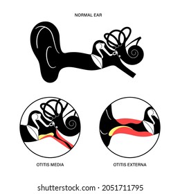 Otitis externa, swimmers ear disease. Pain and inflammation, earache in the human head. Medical checkup of hearing organs, neurology problems and treatment flat vector illustration. Poster for clinic