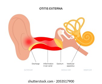 Otitis externa, swimmers ear disease. Pain and inflammation, earache in the human head. Medical checkup of hearing organs, neurology problems and treatment flat vector illustration. Poster for clinic