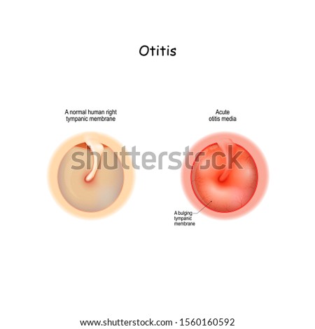 otitis. Healthy membrane, and bulging tympanic membrane of Acute otitis media. Vector illustration for medical use