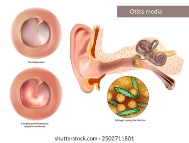 Otitis media o supurativa crónica. Patógeno causante de la infección. Tímpano normal e inflamación e inflamación de la membrana timpánica. 