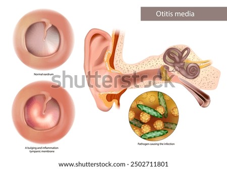 Otitis Media or Chronic Suppurative. Pathogen causing the infection. Normal eardrum and bulging and inflammation tympanic membrane. 