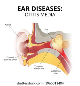 Otitis media, Entwicklung und Symptome der Krankheit, die Struktur des menschlichen Ohrs in einem Abschnitt