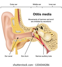 Otitis media ear disease 3d medical vector illustration on white background