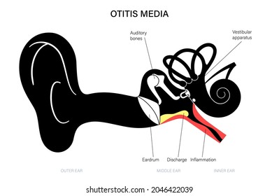 Otitis media, ear disease concept. Pain and inflammation, earache in the human head. Medical checkup of hearing organs, neurology problems and treatment, flat vector illustration. Poster for clinic.