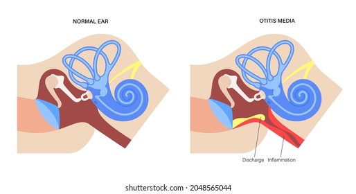 Otitis media, ear disease concept. Pain and inflammation, earache in the human head. Medical checkup of hearing organs, neurology problems and treatment, flat vector illustration.