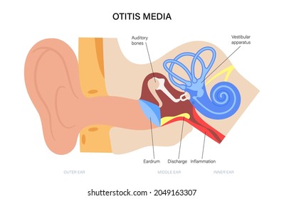 Otitis media, concepto de enfermedad de oído. Dolor e inflamación, dolor de oído en la cabeza humana. Control médico de órganos auditivos, problemas neurológicos y tratamiento, ilustración vectorial plana. Afiche de la clínica.