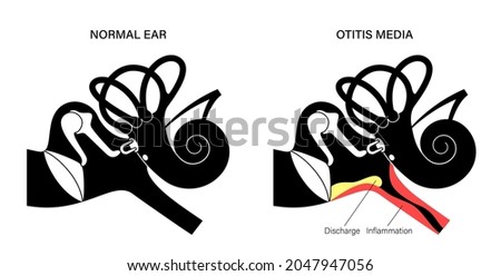 Otitis media, ear disease concept. Pain and inflammation, earache in the human head. Medical checkup of hearing organs, neurology problems and treatment, flat vector illustration.