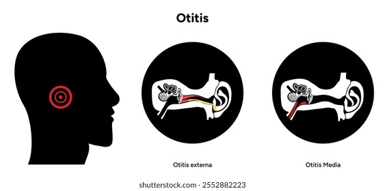 Otitis media and externa human ear anatomy disease medical infographic