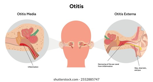 Otite média e inflamação externa anatomia dor no ouvido humano doença médica infográfica