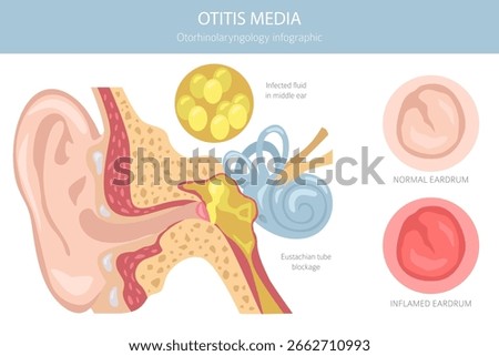 Otitis media. Infection in the middle ear. Otological disorders infographic. Vector illustration