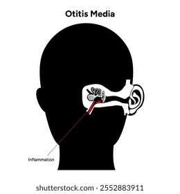 Otitis media inflammation anatomy human ear pain disease medical infographic