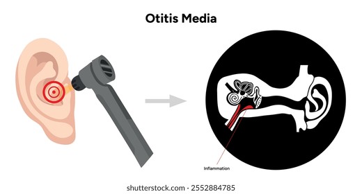 Otite média inflamação anatomia dor no ouvido humano doença infográfica médica e check-up em consulta médica