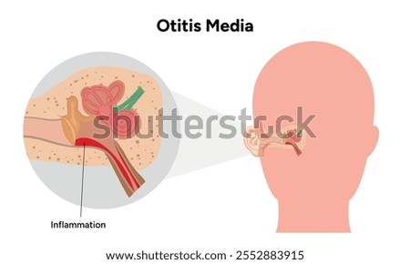 Otitis media inflammation anatomy human ear pain disease medical infographic