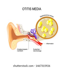 La otitis media es inflamación del oído medio. infecciones bacterianas. Cerca de Staphylococcus aureus.  Anatomía humana. ilustración para uso médico