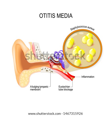 Otitis media is inflammation of the middle ear. bacterial infections disease. Close up of  Staphylococcus aureus. Human anatomy. illustration for medical use Foto stock © 