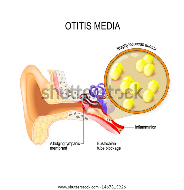 中耳炎は中耳の炎症です 細菌感染症 黄色ブドウ球菌の接写 人間の解剖学 医療用イラスト のベクター画像素材 ロイヤリティフリー
