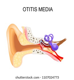 Otitis Media Is A Inflammatory Diseases Of The Middle Ear. Human Anatomy. Vector Illustration For Medical Use