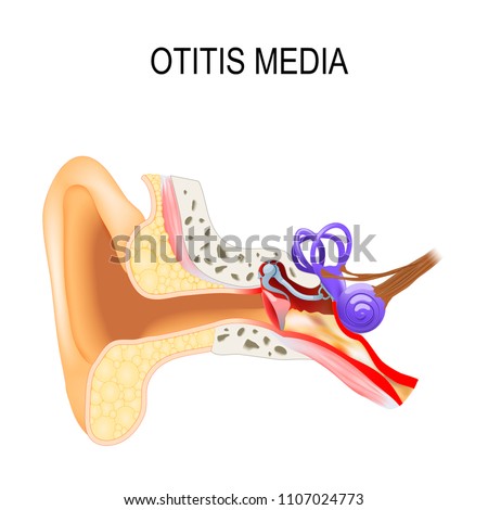 Otitis media is a inflammatory diseases of the middle ear. Human anatomy. Vector illustration for medical use Foto stock © 