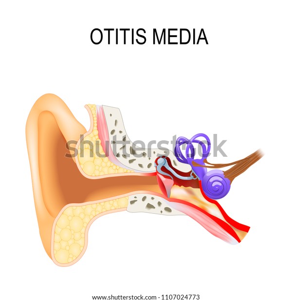中耳炎は中耳の炎症性疾患です 人間の解剖学 医療用ベクターイラスト のベクター画像素材 ロイヤリティフリー
