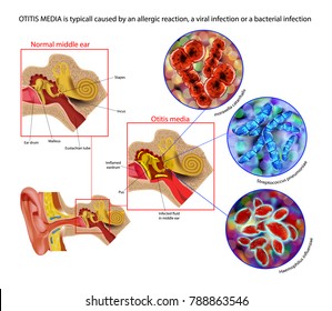 Otitis media is typicall caused by an allergic reaction, a viral infection or a bacterial infection