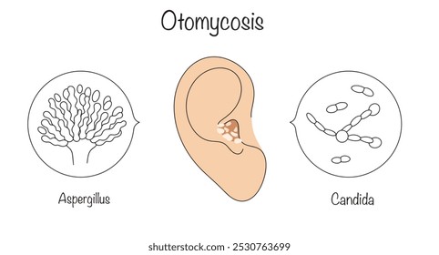 Otomicose. Infecção fúngica do canal auditivo externo. Uma orelha puxada à mão com a manifestação da doença e os agentes causadores da doença. Ilustração vetorial.