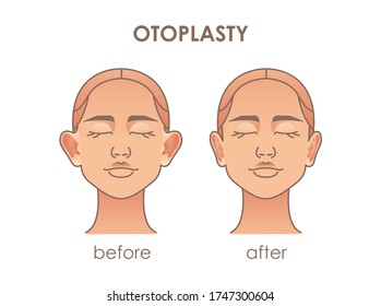 Otoplasty. Ear surgery. Vector illustration of female face before and after. Plastic surgery. For youe design