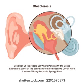 Otosclerosis. Medical condition of the middle ear bones inside the ear which causes gradual hearing loss. Abnormal bone growth in the middle ear. Flat vector illustration