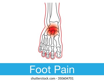 Outline of foot and bone which have pain on top of foot. This is medical illustration.
