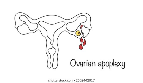 Ovarian apoplexy. Violation of the integrity of ovarian tissue during ovulation. Sudden hemorrhage into the abdominal cavity due to the rupture of one or more vessels. Hand drawn medical illustration.