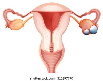 Ovarian cancer diagram in woman illustration