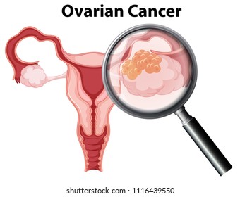 Ovarian Cancer on White Background illustration