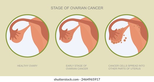 Ovarian cancer refers to any cancerous growth that begins in the ovaries.The organs that produce eggs in females. Stage of ovarian cancer, vector illustration. 