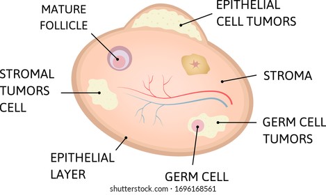 Ovarian Cancer Is A Cancer That Forms In Or On An Ovary. Cancer Of Epithelial Layer,  Germ Cell, Stromal Tumors Cell. Medical Vector Illustration Isolated On White.