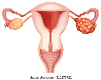 Рак яичников в иллюстрации женщины