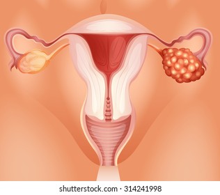 Ovarian cancer in woman illustration