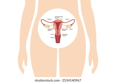 Ovarian and cervical cancer, cervical disorder, endometriosis, hysterectomy, uterine fibroids, reproductive system, menstruation