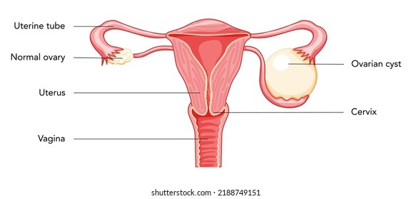 Ovarian Cyst Female Reproductive System Uterus In Anatomical Infographic Diagram With Inscriptions In Latin Text. Human Anatomy Internal Organs Location Scheme, Cervix, Ovary, Fallopian Tube Flat