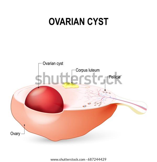 Ovarian Cyst Fluidfilled Sac Ovary Stock Vector (Royalty Free) 687244429