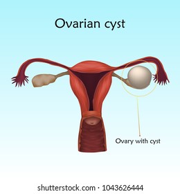 Ovarian Cyst Human Realistic Uterus Anatomy Stock Vector (Royalty Free ...