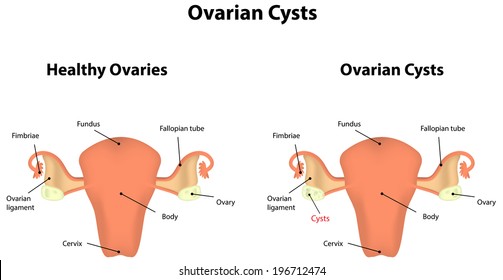 Ovarian Cysts