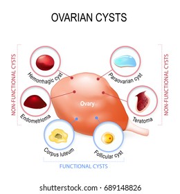 Ovarian cysts