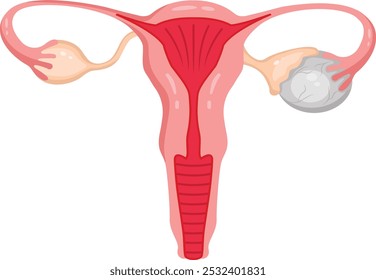 Cistos ovarianos com sistema reprodutor feminino.Doença ovariana feminina vetor.