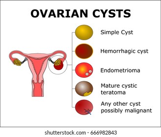 Ovarian Cystscolor Vector Illustration Stock Vector (Royalty Free ...