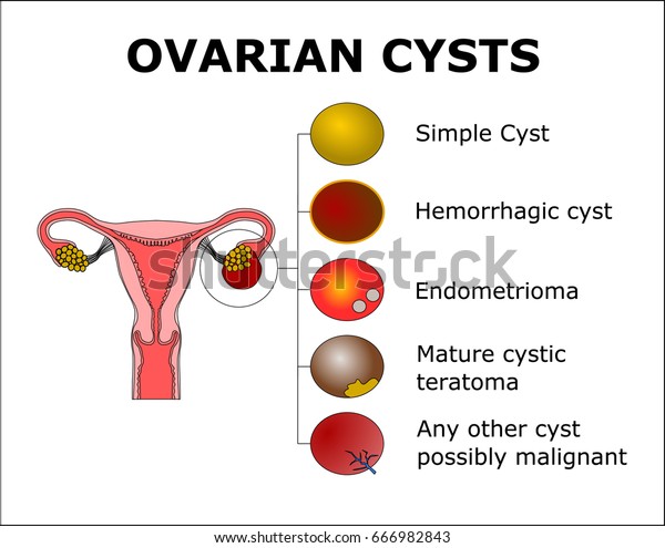 Ovarian Cystscolor Vector Illustration Stock Vector (Royalty Free ...